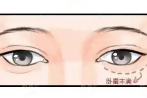 手術(shù)5W花得值-淺談杜園園脂肪填充去眼袋厲害的八個地方和修復(fù)的口碑與質(zhì)量