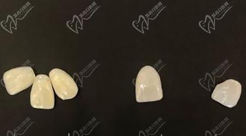 樹脂貼面和瓷貼面對(duì)比