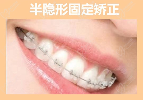 金華婺城口腔醫(yī)院半隱形固定矯正