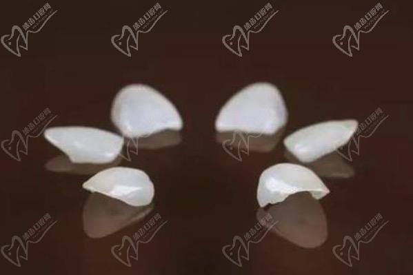 牙齒貼面多久可以做好？