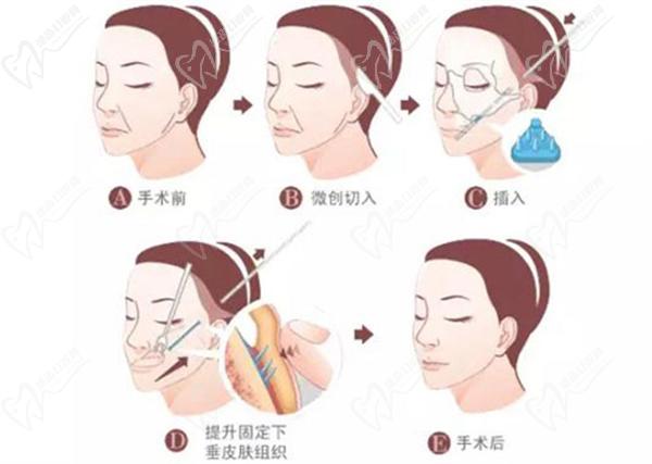 拉皮手術(shù)全程