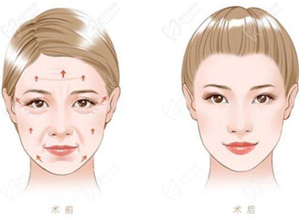 拉皮手術(shù)前后對(duì)比