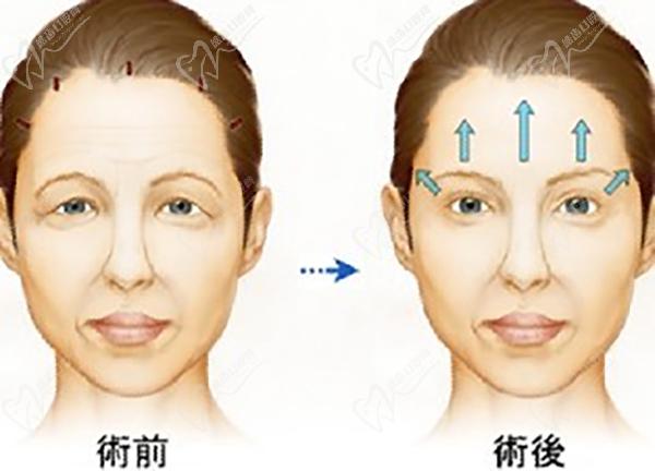 拉皮手術(shù)
