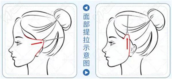 拉皮除皺
