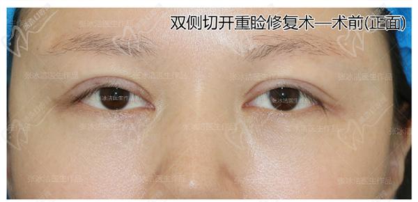 張冰潔雙眼皮修復(fù)案 例圖：肉條腫過寬過深、睜眼費力眼睛無神