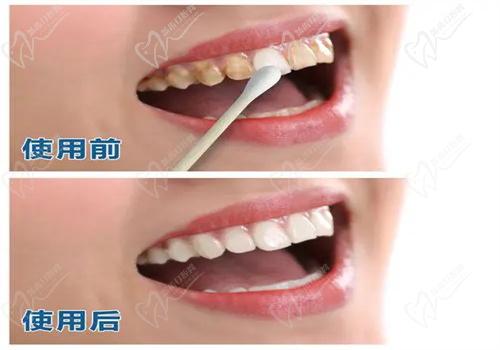 牙齒美白有哪些方法？