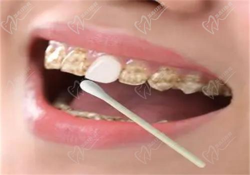 牙齒美白有哪些方法？
