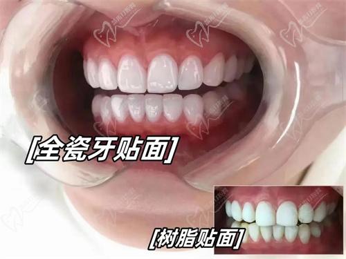 牙齒貼面種類(lèi)