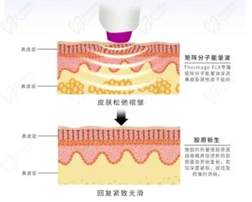 重慶軍科整形引進超瑪吉FLX技術(shù)不錯
