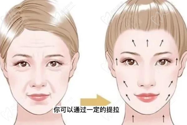 拉皮面部筋膜提升