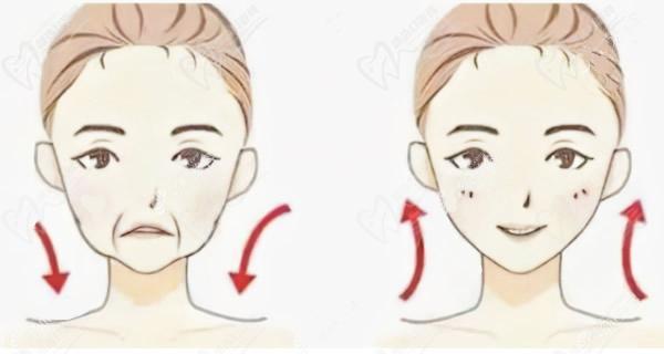 拉皮面部筋膜提升