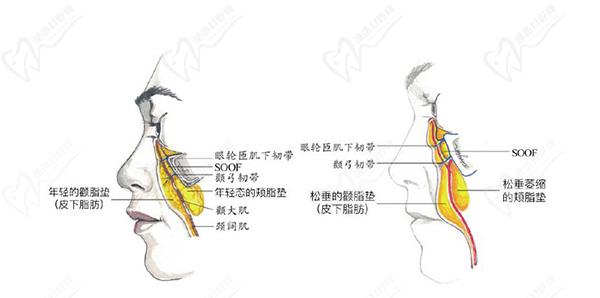 拉皮面部筋膜提升