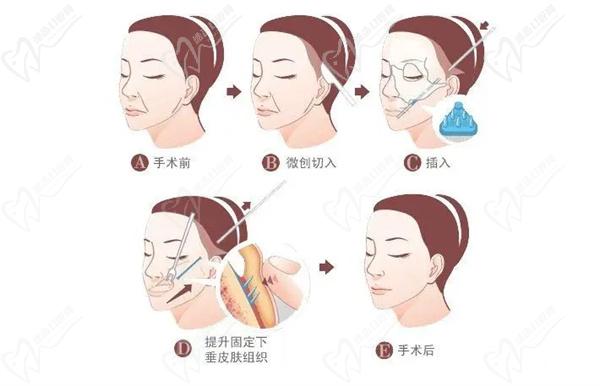拉皮面部筋膜提升