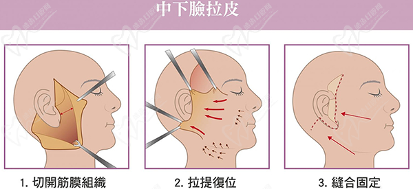 拉皮面部筋膜提升