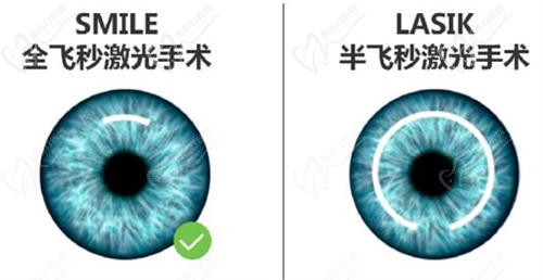 昆明近視手術(shù)哪家醫(yī)院好？
