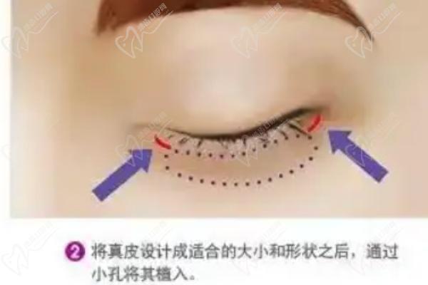 外眥修復(fù)、提升、成形術(shù)的區(qū)別與選擇