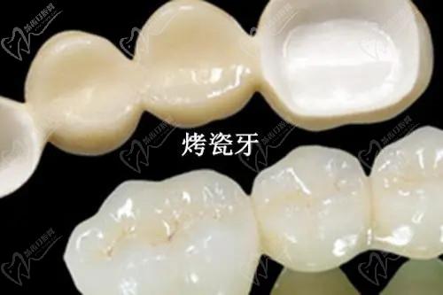 各地區(qū)牙齒貼面多少錢？2025價(jià)格表：