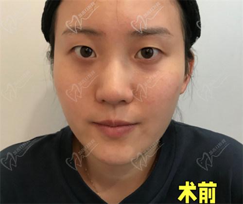 為什么選擇杜園園醫(yī)生做雙眼皮手術(shù)？