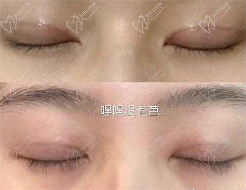 北京豐聯(lián)麗格醫(yī)療美容師麗麗修復(fù)雙眼皮怎么樣？