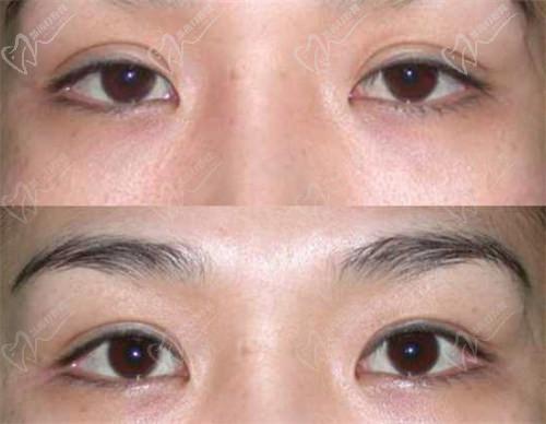 三、北京師麗麗雙眼皮修復(fù)與內(nèi)眼角修復(fù)的成功實(shí)例：