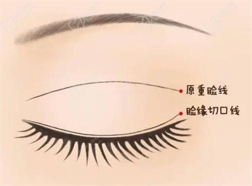 三、影響北京豐聯(lián)麗格整形醫(yī)院做雙眼皮價(jià)格的因素