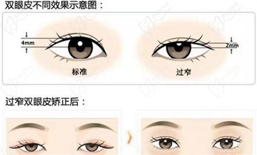 六、北京豐聯(lián)麗格整形醫(yī)院師麗麗醫(yī)生雙眼皮手術(shù)預(yù)約掛號方式