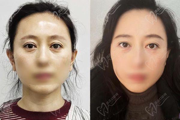 上海張詩若修復(fù)雙眼皮內(nèi)眼角怎么樣