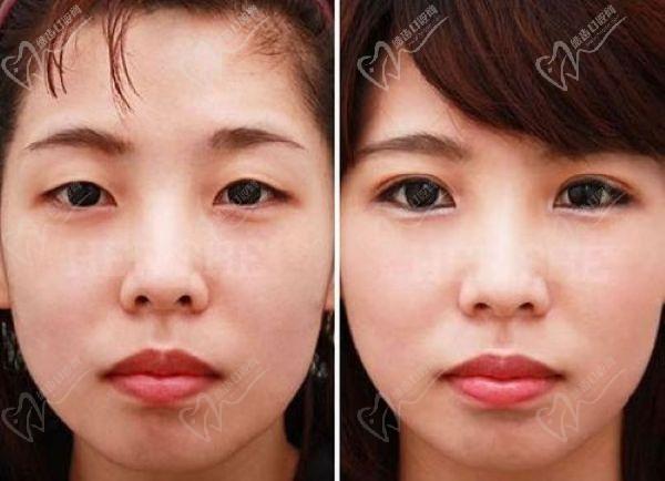 上海張詩若修復(fù)雙眼皮內(nèi)眼角價格多少錢