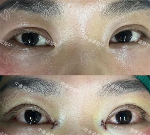 田芳斌醫(yī)生眼修復(fù)真人實(shí)例