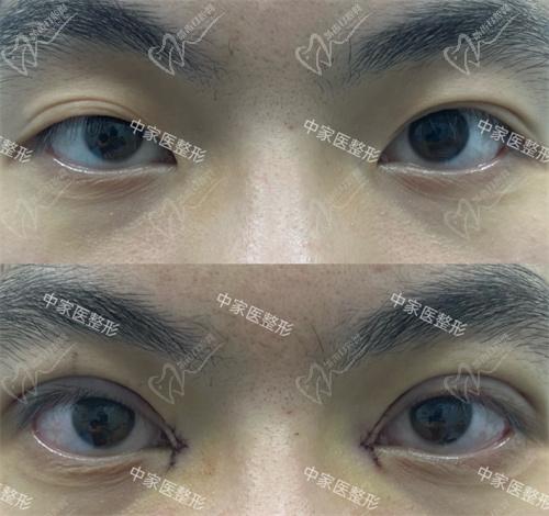田芳斌醫(yī)生眼修復(fù)真人實(shí)例
