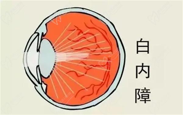 上海醫(yī)大眼科白內(nèi)障手術(shù)8千-3萬起，不同品牌晶體價(jià)格有些許差異
