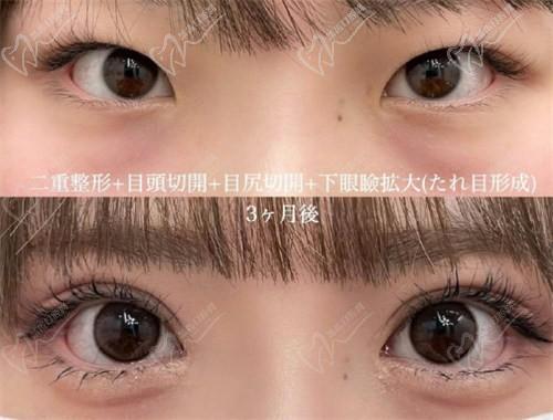 北京豐聯(lián)麗格醫(yī)療美容師麗麗修復雙眼皮怎么樣？肉條眼修復解決假寬深疤痕更隱形