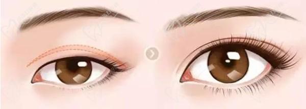 上海杜園園做眼睛失敗修復(fù)病例眾多，技術(shù)靠譜案例多，高難度眼修復(fù)難題不在話下